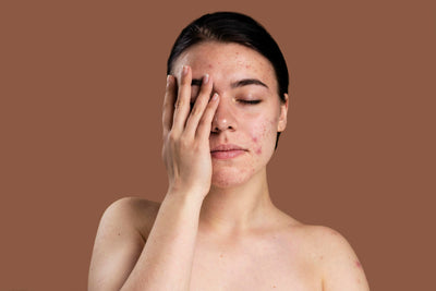 Do Acne Scars Go Away?